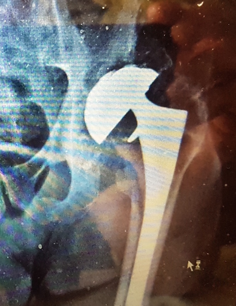 Zimmer Bias Total Hip Revision Femoral Component (Implant 170825)